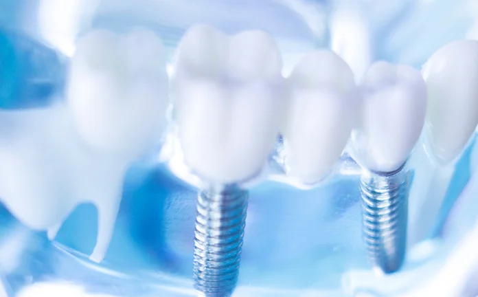 Dental Implants